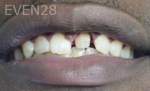 Artur-Arkelakyan-Dental-Crowns-before-2