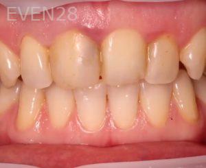 Artur-Arkelakyan-Dental-Crowns-before-3