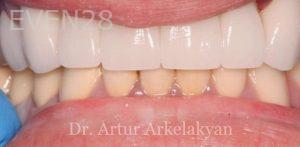 Artur-Arkelakyan-Dental-Implants-after-1