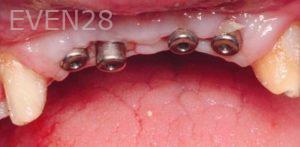 Artur-Arkelakyan-Dental-Implants-before-1