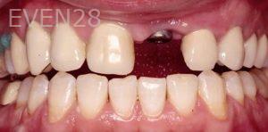 Artur-Arkelakyan-Dental-Implants-before-2