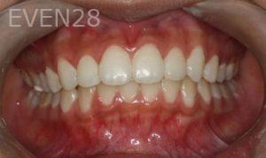 Bob-Perkins-Orthodontic-Braces-after-2