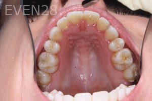 Bob-Perkins-Orthodontic-Braces-after-5