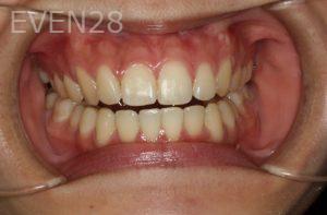 Bob-Perkins-Orthodontic-Braces-after-6b