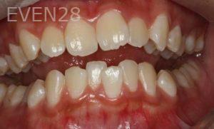 Bob-Perkins-Orthodontic-Braces-before-2