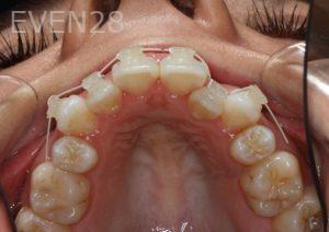 Bob-Perkins-Orthodontic-Braces-before-5