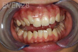 Bob-Perkins-Orthodontic-Braces-before-6b