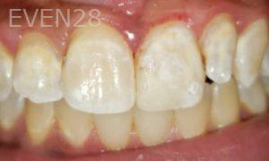 Dan-Beroukhim-Dental-Bonding-after-1