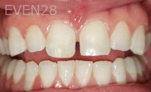 Dan-Beroukhim-Dental-Bonding-after-2