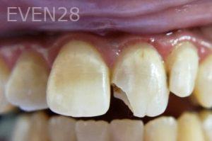 Dan-Beroukhim-Dental-Bonding-before-1