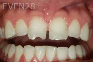 Dan-Beroukhim-Dental-Bonding-before-2