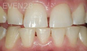 Dan-Beroukhim-Dental-Cleaning-after-1
