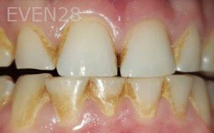 Dan-Beroukhim-Dental-Cleaning-before-1