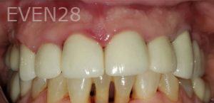 Dan-Beroukhim-Dental-Crowns-after-1