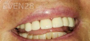 Dan-Beroukhim-Dental-Crowns-after-1b