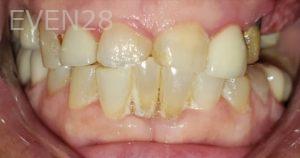 Dan-Beroukhim-Dental-Crowns-before-1