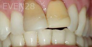 Dan-Beroukhim-Dental-Crowns-before-2
