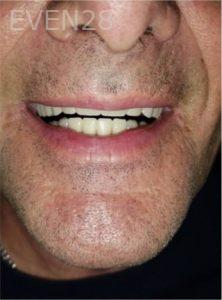 Dan-Beroukhim-Dentures-after-1