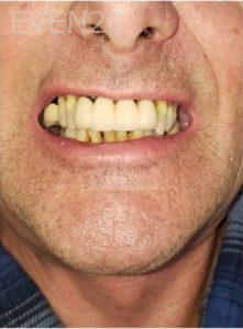 Dan-Beroukhim-Dentures-before-1