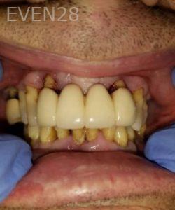 Dan-Beroukhim-Dentures-before-1b
