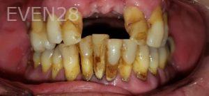 Dan-Beroukhim-Dentures-before-2