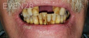 Dan-Beroukhim-Dentures-before-2b
