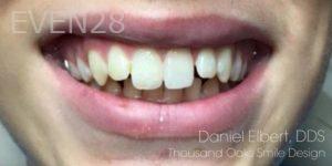Daniel-Elbert-Dental-Bonding-after-2