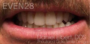 Daniel-Elbert-Dental-Bonding-after-3