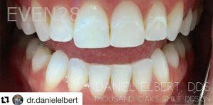 Daniel-Elbert-Dental-Bonding-after-5