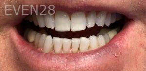 Daniel-Elbert-Dental-Bonding-before-1