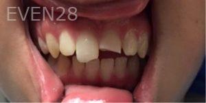 Daniel-Elbert-Dental-Bonding-before-2