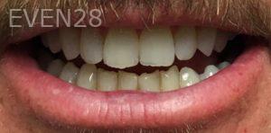 Daniel-Elbert-Dental-Bonding-before-3