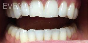 Daniel-Elbert-Dental-Bonding-before-4