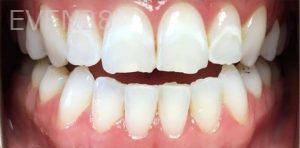 Daniel-Elbert-Dental-Bonding-before-5