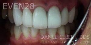 Daniel-Elbert-Dental-Crowns-after-1