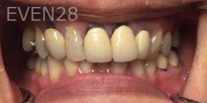 Daniel-Elbert-Dental-Crowns-before-1