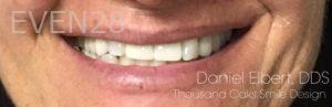 Daniel-Elbert-Dental-Implants-after-1b