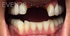 Daniel-Elbert-Dental-Implants-before-1