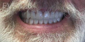 Daniel-Elbert-Implant-Supported-Over-Dentures-after-1