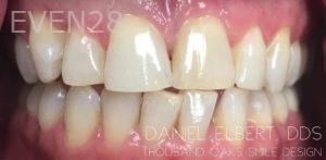 Daniel-Elbert-Teeth-Whitening-after-1