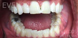 Daniel-Elbert-Teeth-Whitening-after-3