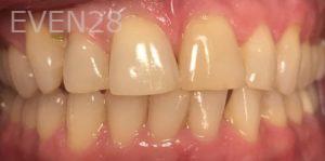 Daniel-Elbert-Teeth-Whitening-before-1