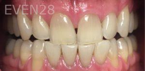 Daniel-Elbert-Teeth-Whitening-before-2