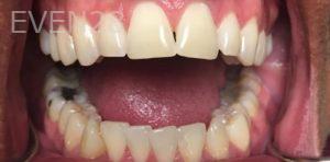 Daniel-Elbert-Teeth-Whitening-before-3