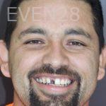 Daniel-Naysan-Dental-Implants-before-1