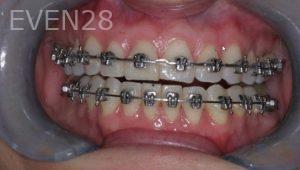David-Frey-Orthodontic-Braces-after-1