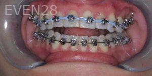David-Frey-Orthodontic-Braces-before-1
