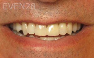 David-Hakimi-Dental-Implants-after-2