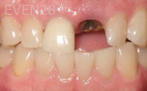 David-Hakimi-Dental-Implants-before-1