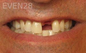 David-Hakimi-Dental-Implants-before-2
